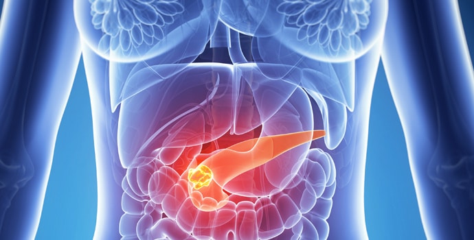 Représentation schématique du cancer pancréatique