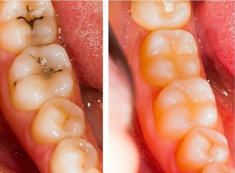 Assiette équilibrée pour des dents saines