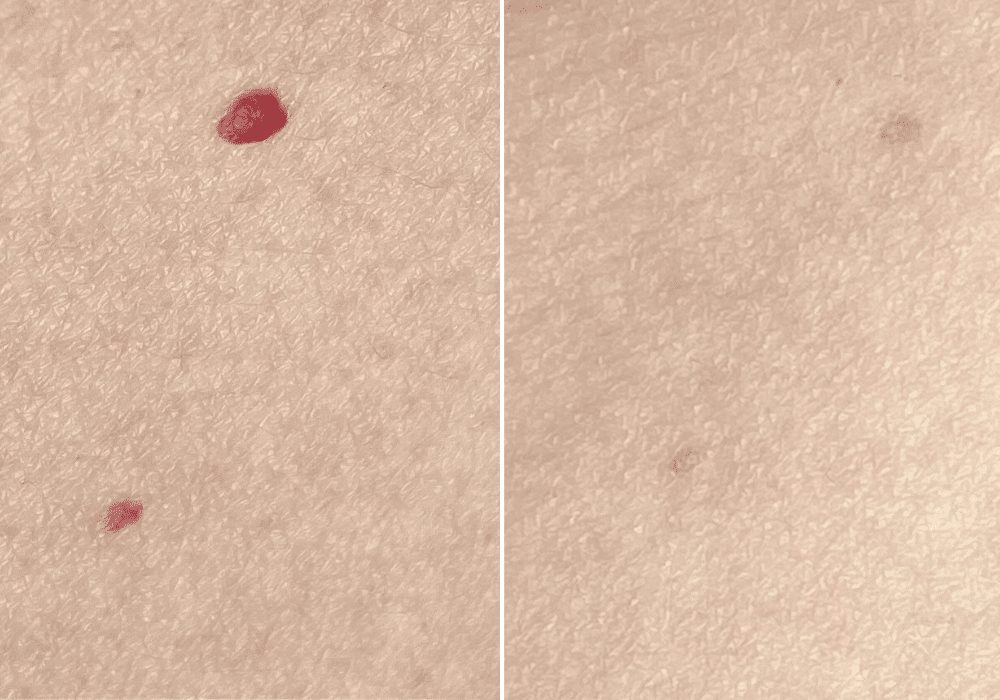 Comparaison avant/après traitement des angiomes