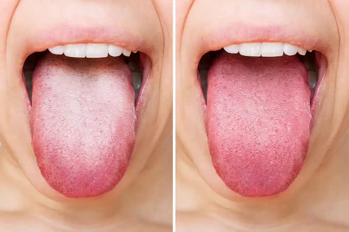 Comparaison de langues saine et recouverte