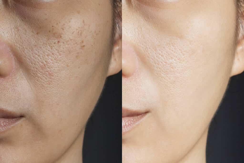 Femme appliquant une crème sur son visage