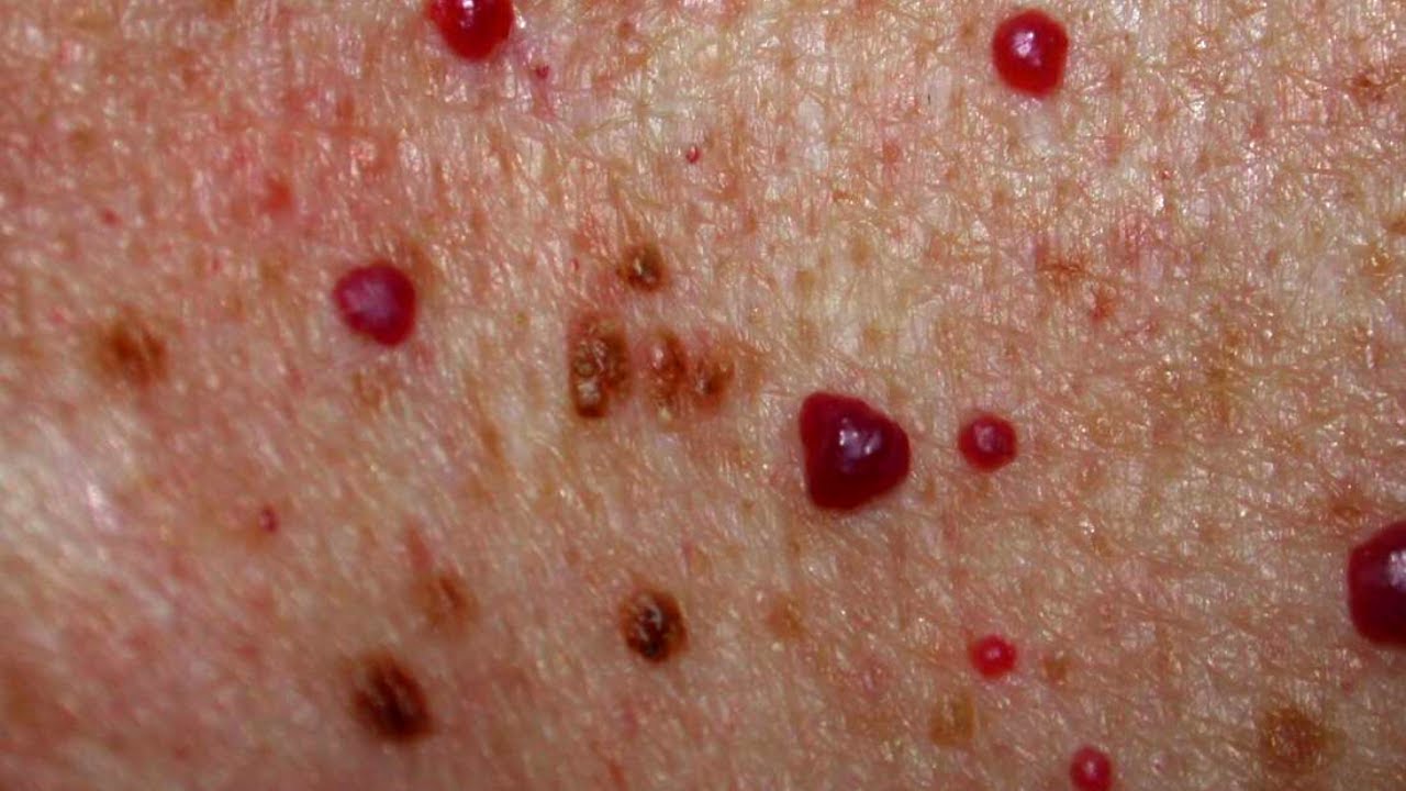 Visage avec rougeurs cutanées