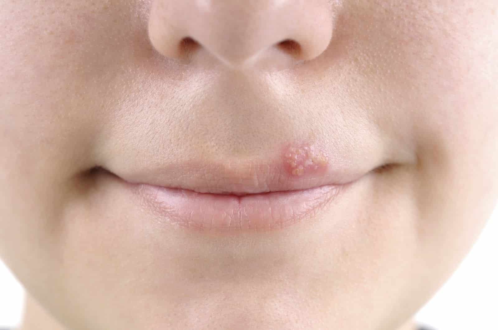 Prévention bouton de fièvre