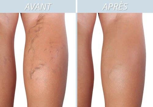 Jambes montrant des varices