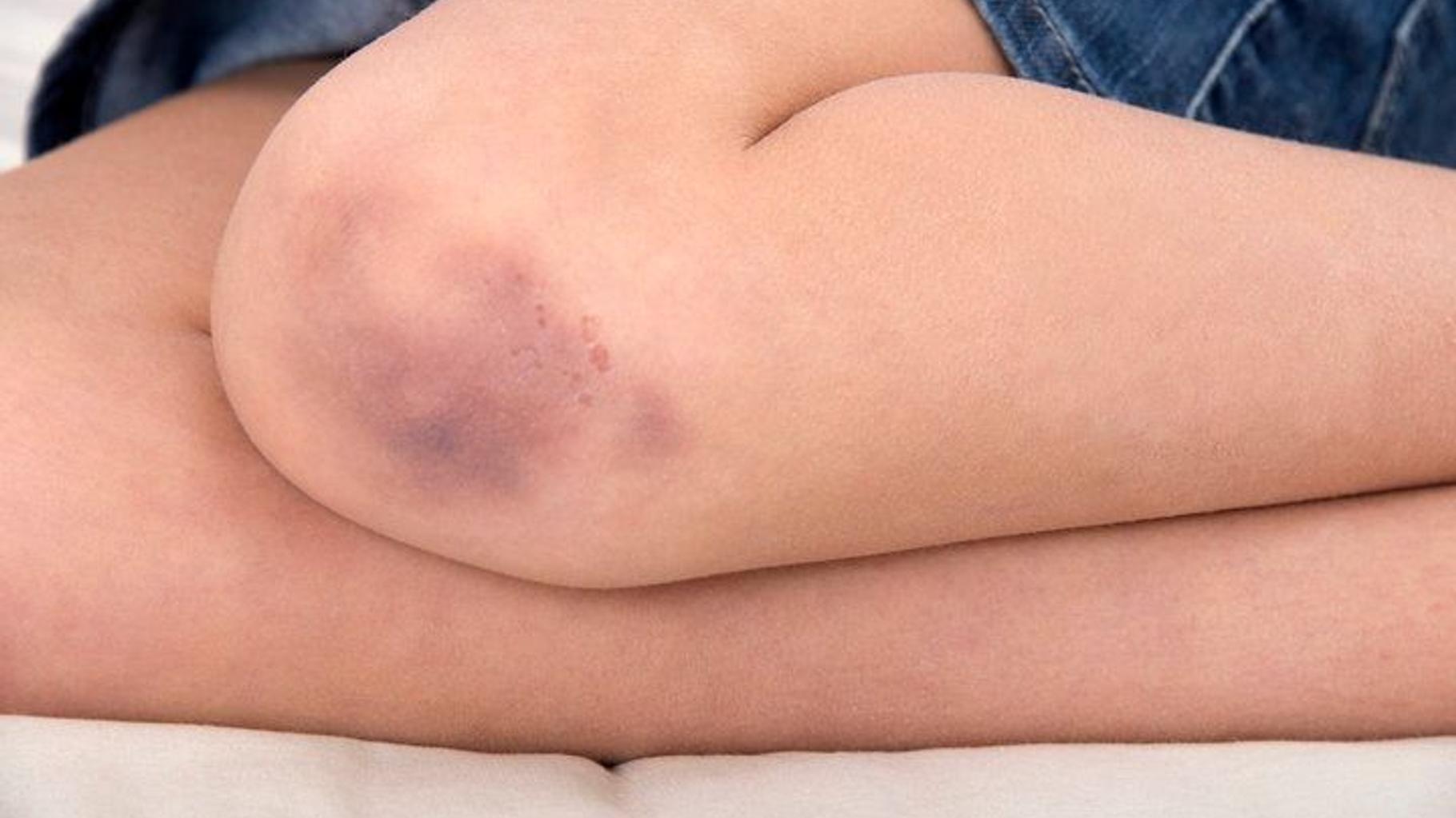 Ecchymose sur la peau