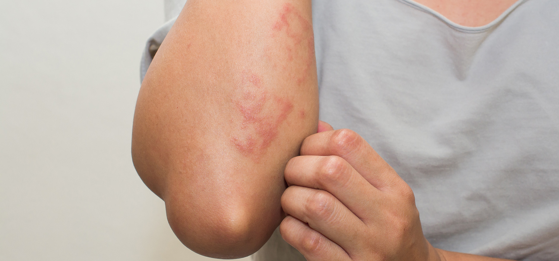 Femme se touchant le visage avec des rougeurs cutanées