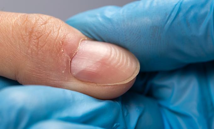 Ongles recourbés vers le bas