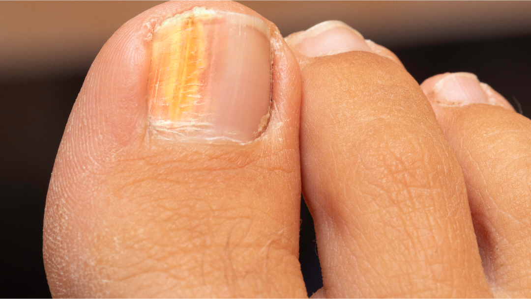 Ongles décolorés en jaune