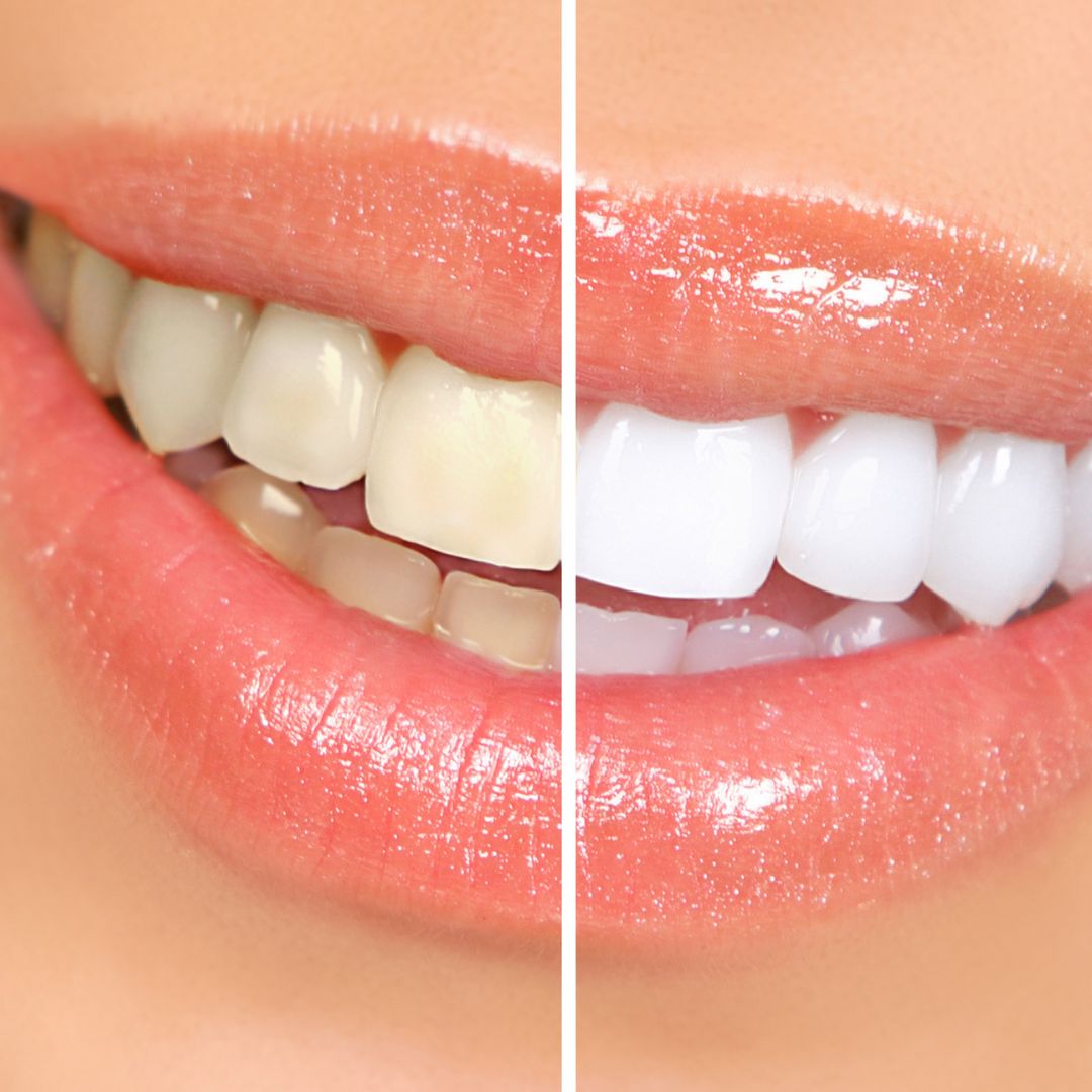 Préparation de dentifrice aux fanes