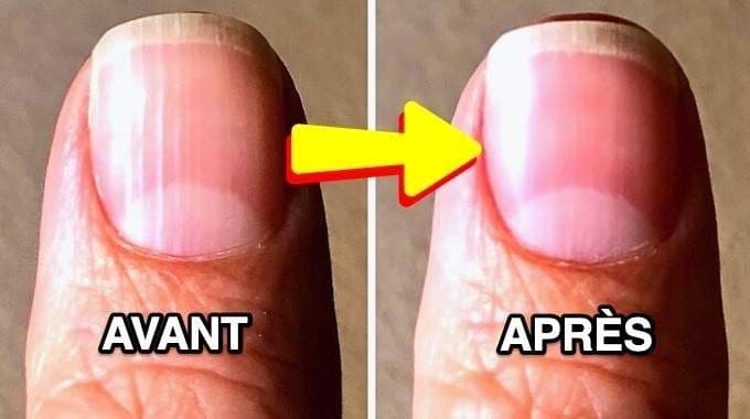 Soin des ongles striés
