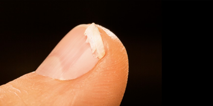 Ongles fragilisés et striés