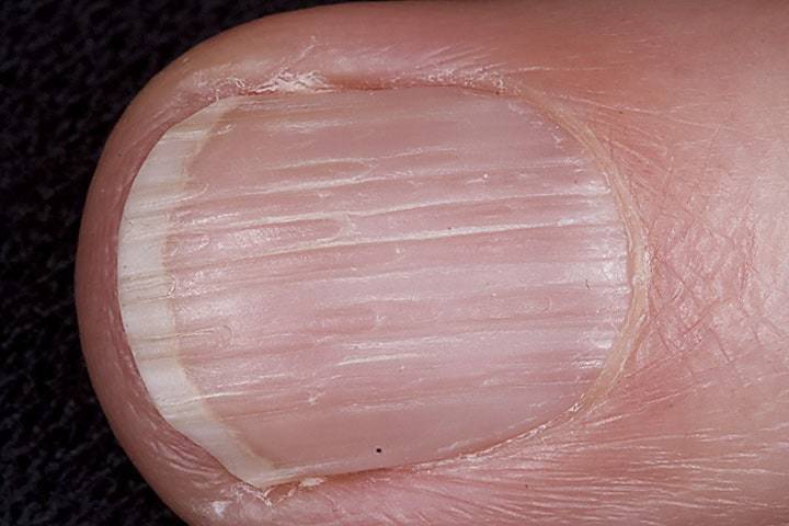 Ongles striés - causes possibles
