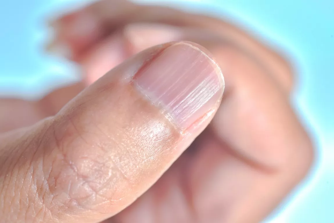 Ongle strié en gros plan