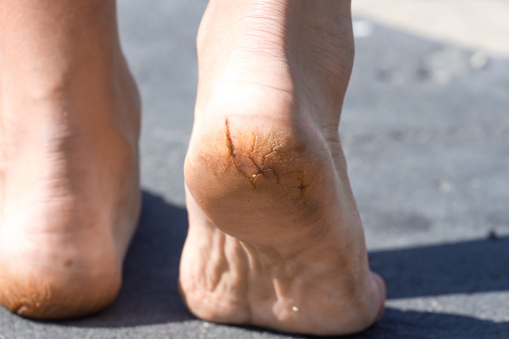 Pieds avec talons secs et crevassés