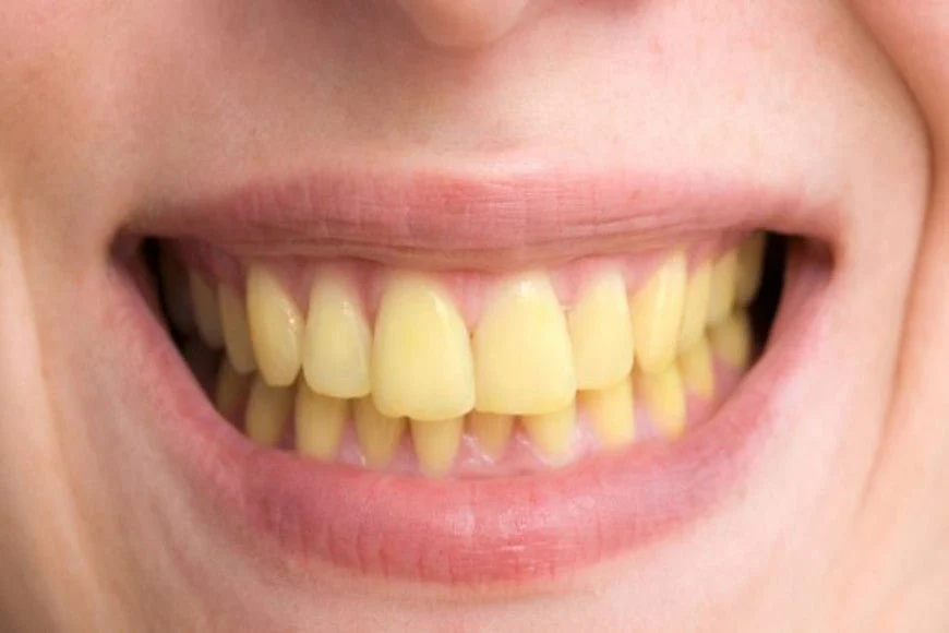 Comparatif avant/après blanchiment naturel des dents