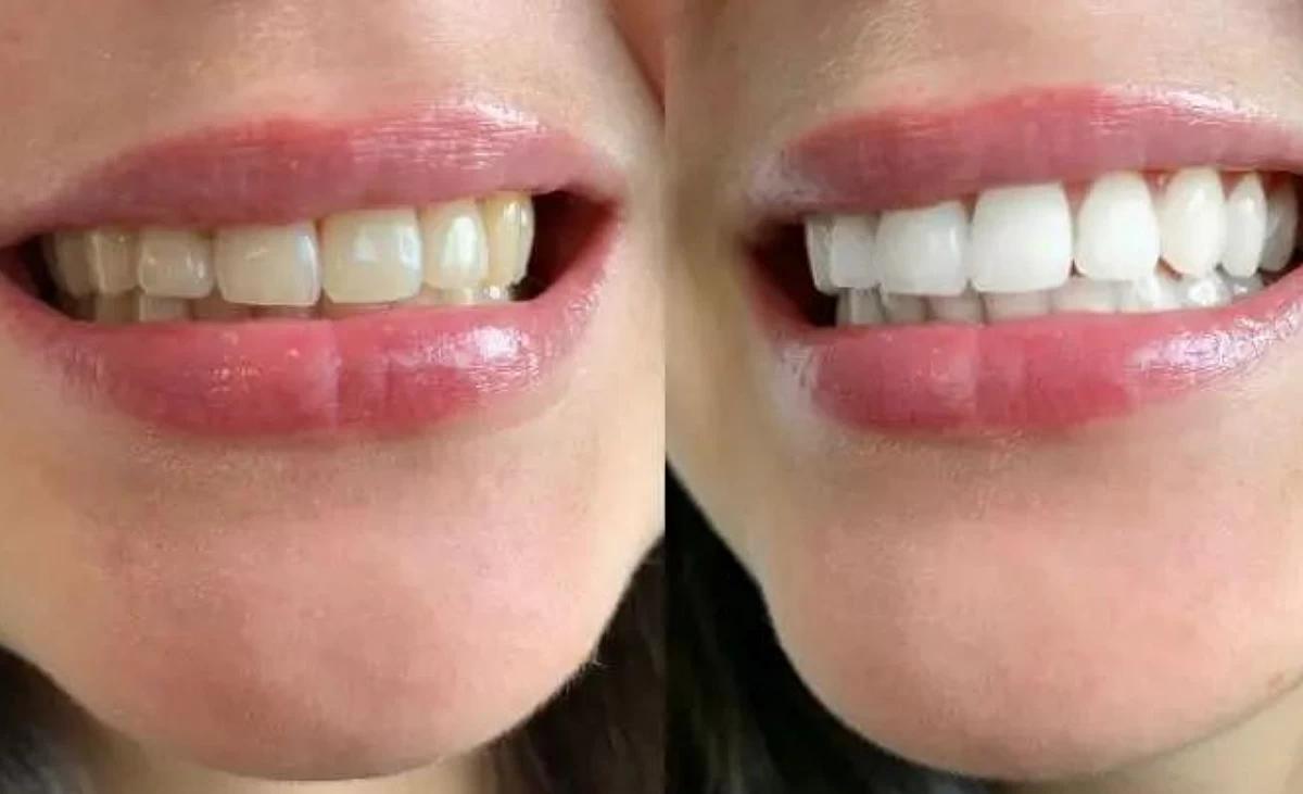 Sourire éclatant après soin naturel