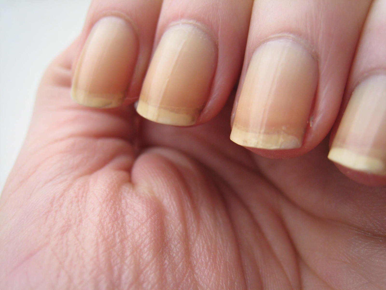 Ongles jaunes et abîmés