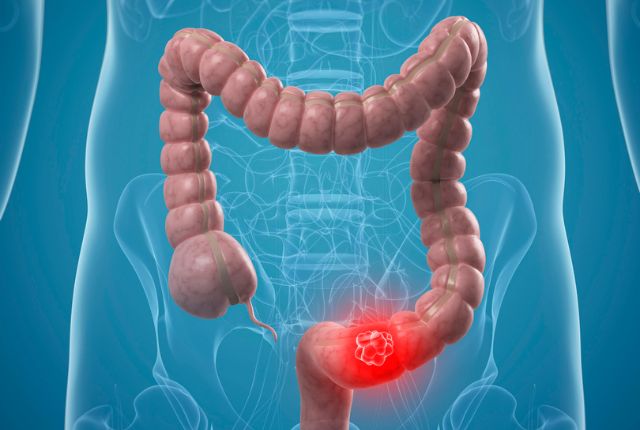 Dépistage cancer colorectal