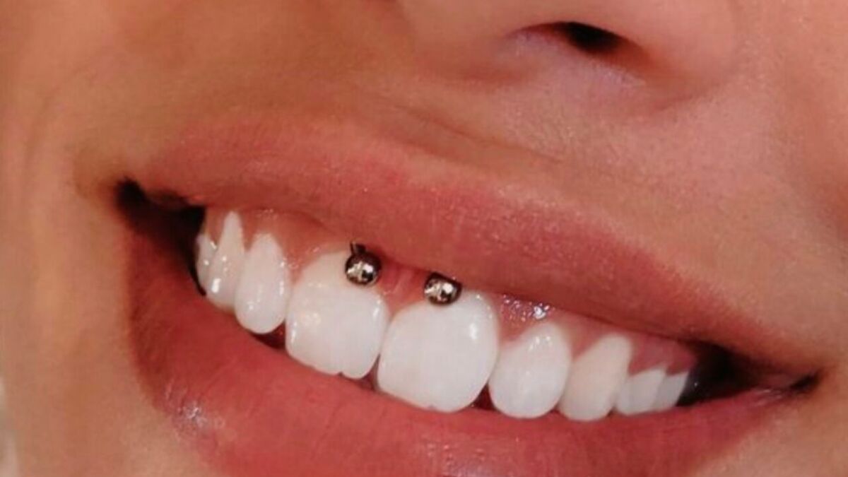 Piercing smiley et soins associés