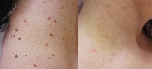 comparaison avant/après traitement d'acrochordon