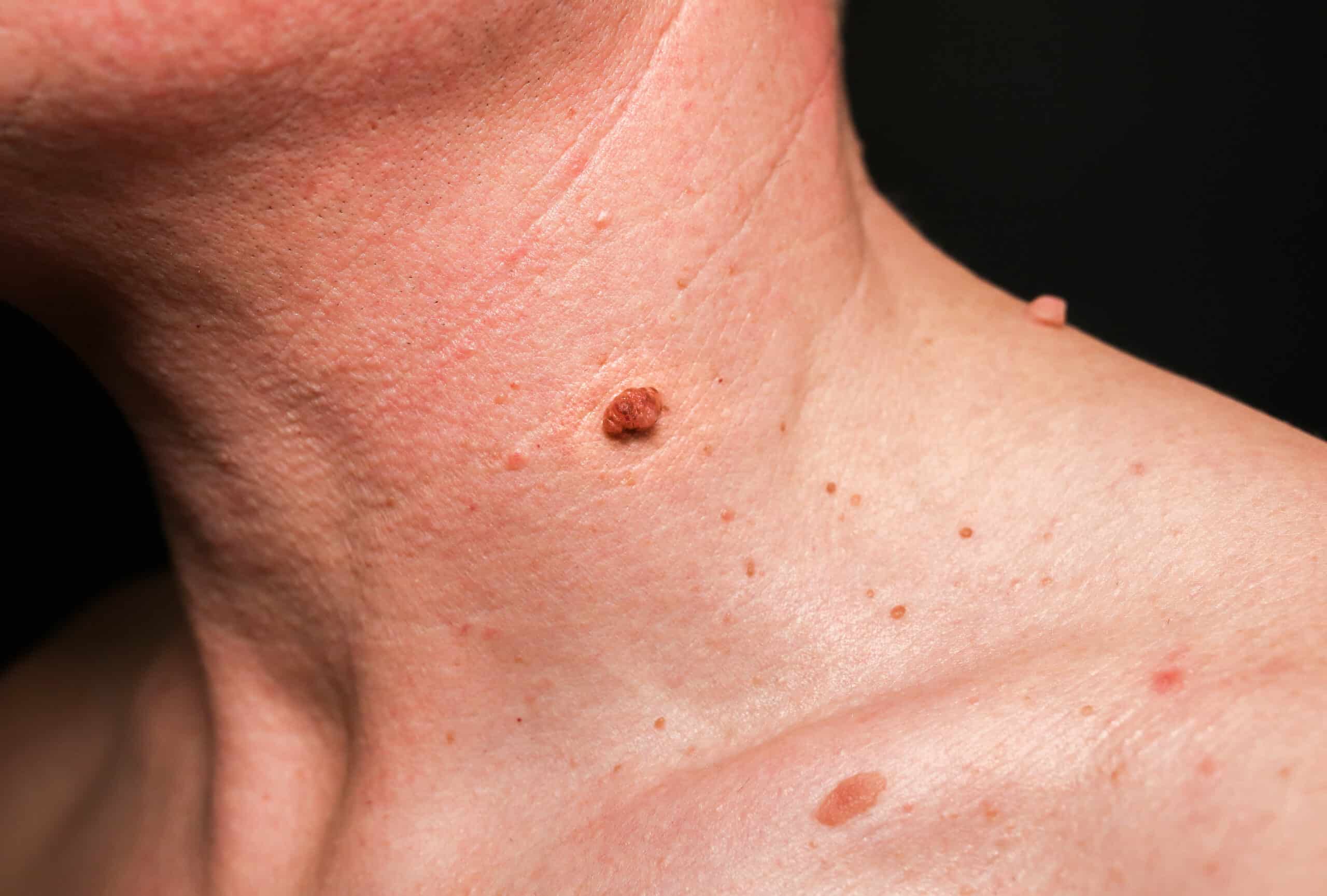 Zoom sur une peau avec de petites imperfections cutanées