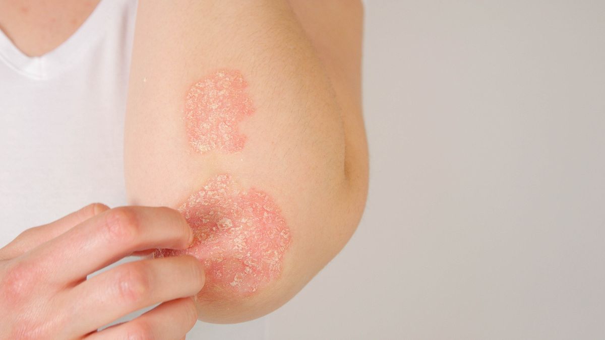 Illustration représentative du psoriasis sur la peau