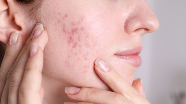 Soin des imperfections et de l'acné