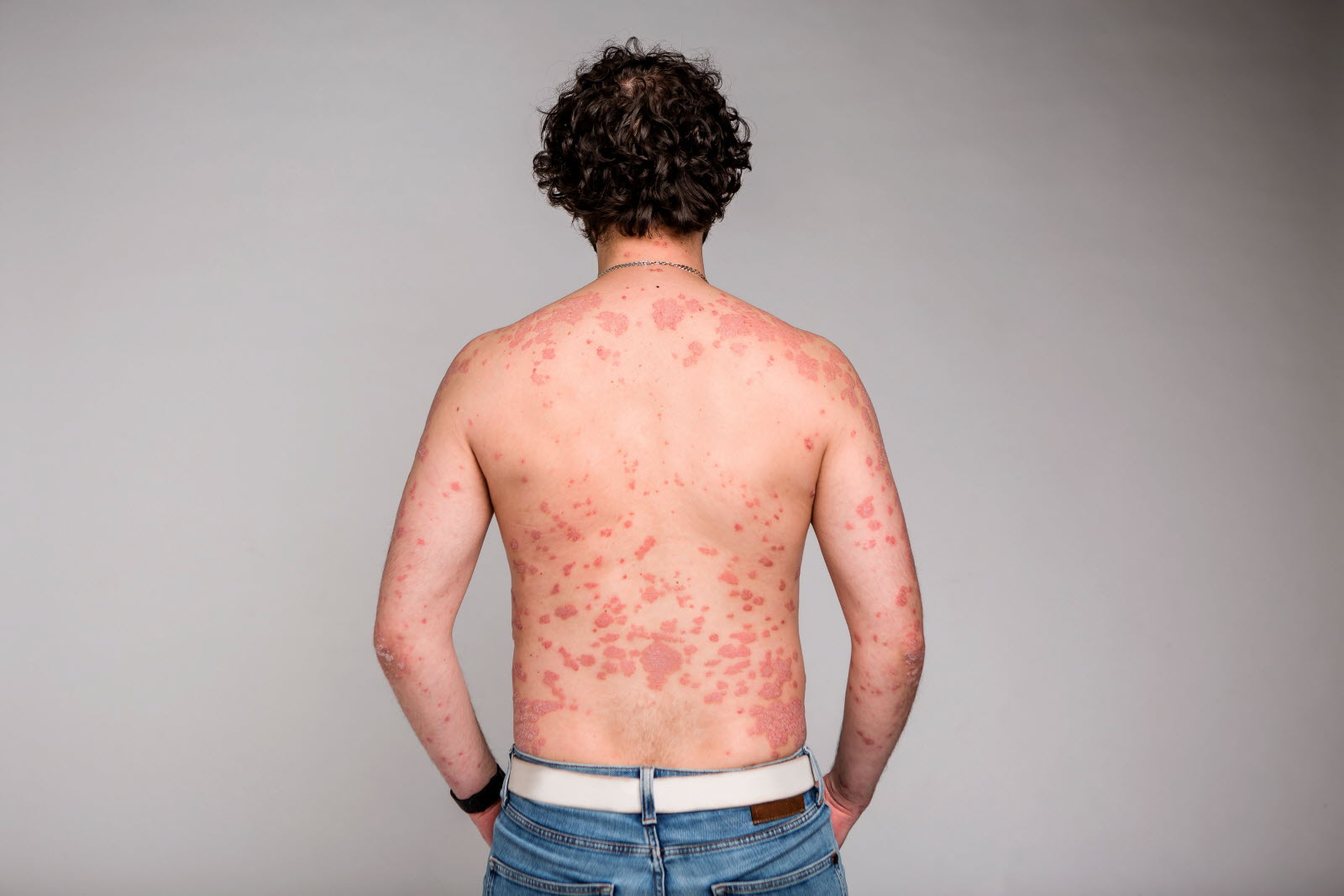Consultation médicale pour le psoriasis - importance du diagnostic précoce