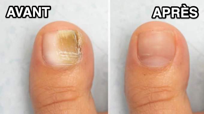Préparation d'un soin pour les ongles