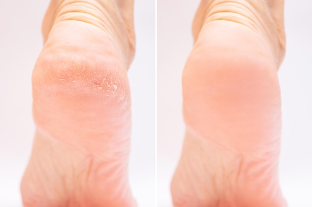 Soin des pieds avant et après application de vaseline